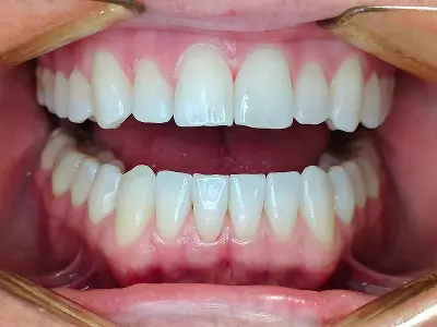 Invisalign Case-1 before-after