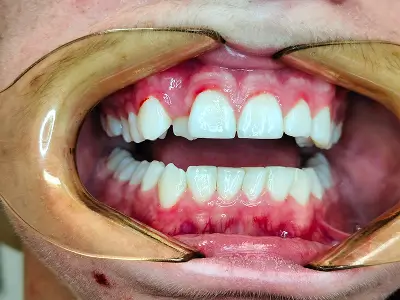 Invisalign Case-2 before-after