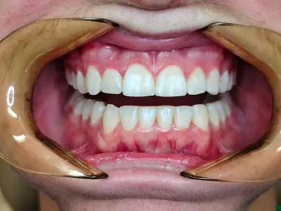 Invisalign Case-2 before-after