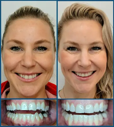 Invisalign in Chatswood Case 3