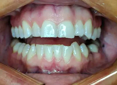 Invisalign Case-3 before-after