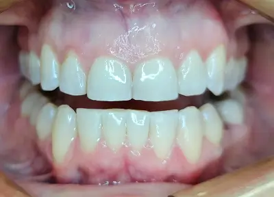 Invisalign Case-3 before-after