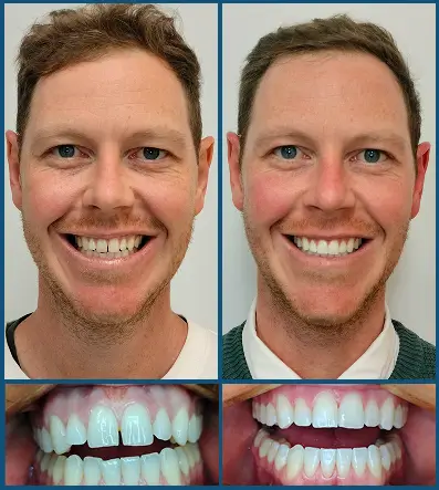 Invisalign in Chatswood Case 1