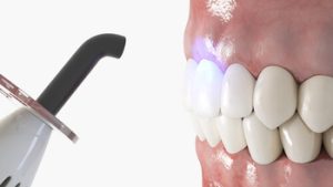 Teeth Whitening or Veneers application
