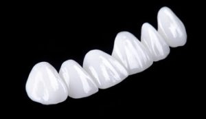 Teeth Whitening or Veneers shells