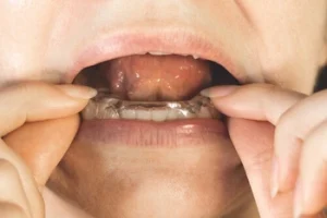 How to Stop Invisalign Pain alignment