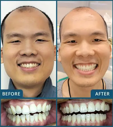 Invisalign in Chatswood Case 29