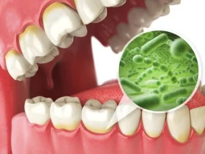 sudden bad breath in toddlers bacteria