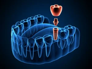 3D illustration of a dental implant, abutment, and crown in a jawbone cross section.