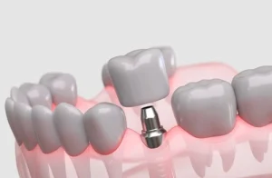Anatomical diagram showing the difference between a healthy tooth and a dental implant.