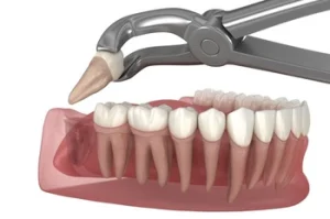 What Does Wisdom Teeth Pain Feel Like extraction