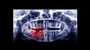 average number of root canals by age xray