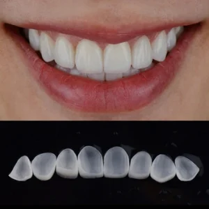 veneers shells in a set