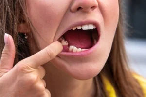 when can i drink alcohol after wisdom tooth extraction removal