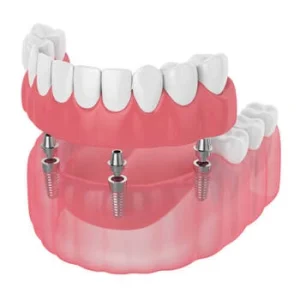 All 4 Dental Implants cost illustration