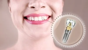 Cost Of Bone Grafting For Dental Implants In Australia before