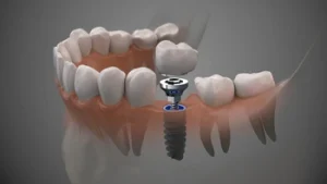Result of a molar tooth implant installation after the surgery.
