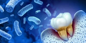 What Can Cause Tooth Decay bacteria What Can Cause Tooth Decay bacteria