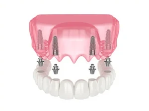 all 4 dental implants cost image