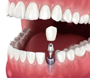 how do dental implant work