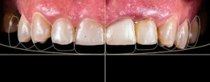 What Causes Root Canal decay What Causes Root Canal decay