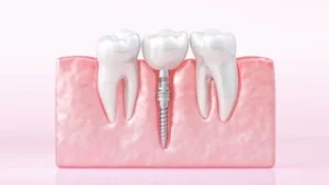 is dental implant safe last