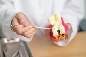 tooth decay illustrated on model tooth decay illustrated on model