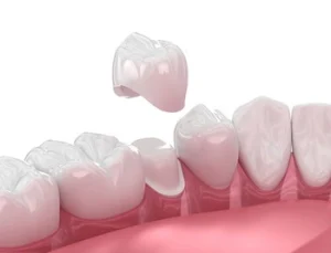 crown shown to be applied on tooth crown shown to be applied on tooth