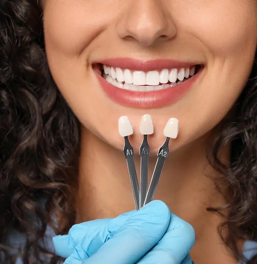 Dental veneer shade comparison for a smiling patient