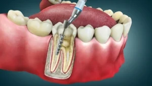 how root canal treatment happens how root canal treatment happens