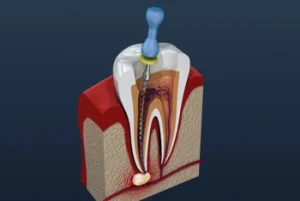 during root canal procedure