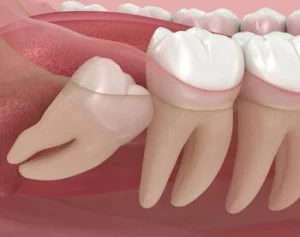 partial eruption of wisdom tooth partial eruption of wisdom tooth