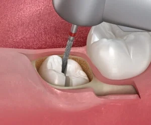 wisdom tooth cut in half for extraction wisdom tooth cut in half for extraction
