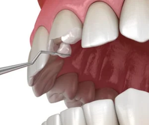 bonding broken tooth