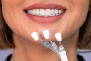 bonding or veneers colour analysis