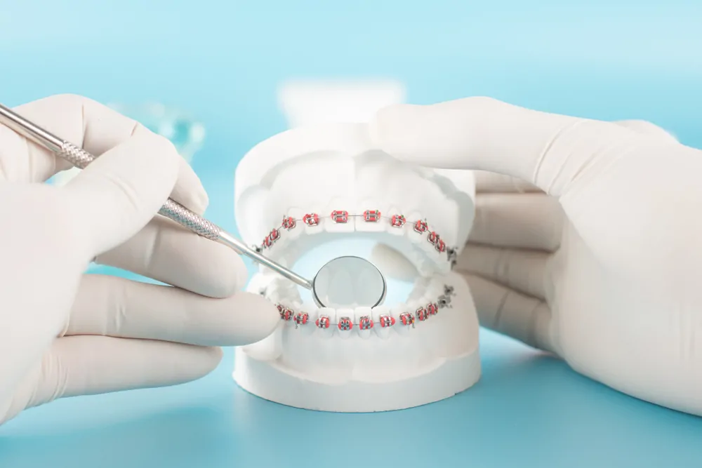 Orthodontist Chatswood demonstrating braces Chatswood on dental model.