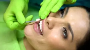 Do Veneers Hurt procedure