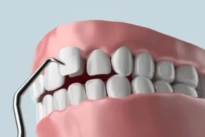 Full Set Of Veneers Cost procedure chatswood