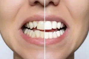 veneers against braces chatswood