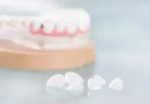 veneers overseas chatswood