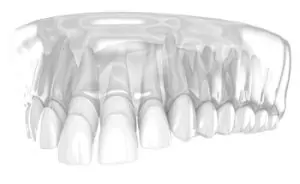  getting veneers while having gum disease chatswood