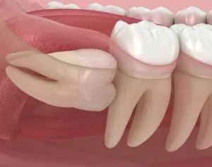 Why Does Wisdom Tooth Pain Come and Go impacted