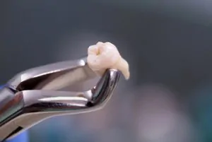 Can You Fly After Tooth Extraction removal